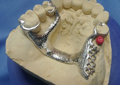 partial dentures hopkins dental lab
