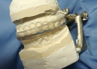 removable dental work hopkins