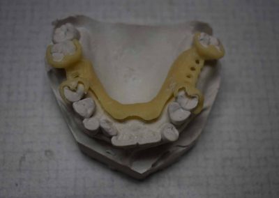 hopkins dental laboratory teeth 2